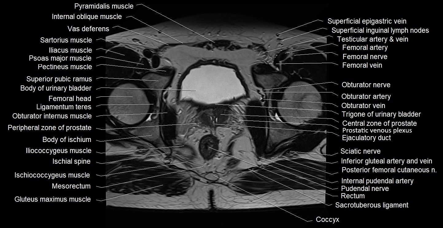 Male pelvis axial cross sectional anatomy image 28.webp